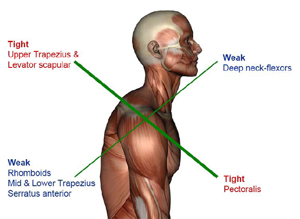 Active Physio Works :: Neck pain? What are these deep neck flexors